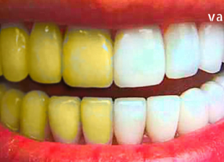 თუ ამას გააკეთებთ ერთი ცდაც საკმარისი იქნება, რომ გქონდეთ ქათქათა კბილები!