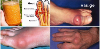 მდოგვისა და თაფლის შესანიშნავი კრემი, რომელიც გასაოცრად კურნავს პოდაგრას, ბურსიტს, ართრიტს და უამრავ სახსრების დაავადებას.