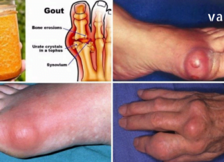 მდოგვისა და თაფლის შესანიშნავი კრემი, რომელიც გასაოცრად კურნავს პოდაგრას, ბურსიტს, ართრიტს და უამრავ სახსრების დაავადებას.