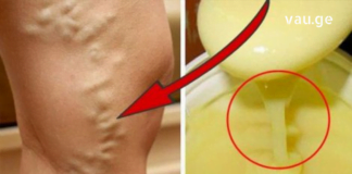 როგორ დავამარცხოთ ვარიკოზული ვენების პრობლება მარტივი გზით?! ამაში ეს ნატურალური საშულებები დაგეხმარებათ..