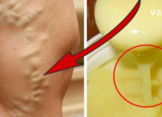 როგორ დავამარცხოთ ვარიკოზული ვენების პრობლება მარტივი გზით?! ამაში ეს ნატურალური საშულებები დაგეხმარებათ..