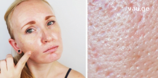 დღეს თქვენთვის იღბლიანი დღეა, რადგან ამ სტატიაში გაგიზიარებთ, როგორ გააკეთოთ საუკეთესო ნიღბები თუ ცხიმიანი კანი გაქვთ