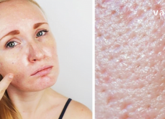 დღეს თქვენთვის იღბლიანი დღეა, რადგან ამ სტატიაში გაგიზიარებთ, როგორ გააკეთოთ საუკეთესო ნიღბები თუ ცხიმიანი კანი გაქვთ