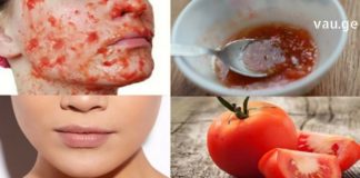 ეფექტური ნიღაბი – თუ გამონაყარი გაწუხებთ, ამ პრობლემას პომიდორი მოგიგვარებთ