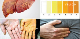 ღვიძლის ცხიმოვანი დაავადების 5 გამაფრთხილებელი ნიშანი