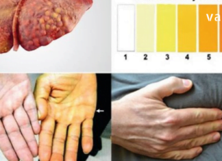 ღვიძლის ცხიმოვანი დაავადების 5 გამაფრთხილებელი ნიშანი