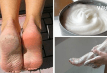 დღეს გაგიზირებთ 4 გამაოგნებელ რეცეპტს დახეთქილი ქუსლების სამკურნალოდ!