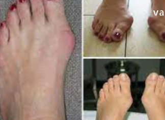 როგორ ვუმკურნალოთ ძვლების შესიებას ექიმთან წასვლის გარეშე.