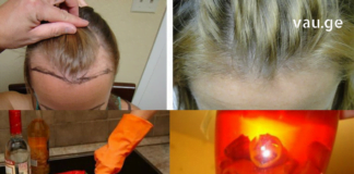 წიწაკამ და ნიორმა თმის ცვენა შემიჩერა – მარტივად მოსამზადებელი წამალი !