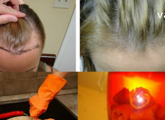 წიწაკამ და ნიორმა თმის ცვენა შემიჩერა – მარტივად მოსამზადებელი წამალი !