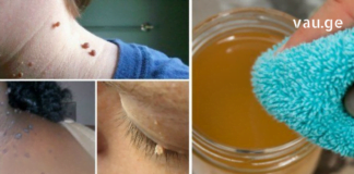 მეჭეჭები საკმაოდ შემაწუხებელი და პრობლემურია. აი ამ მარტივი მეთოდებით შეგიძლიათ მოიცილოთ სამუდამოდ