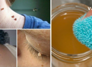 მეჭეჭები საკმაოდ შემაწუხებელი და პრობლემურია. აი ამ მარტივი მეთოდებით შეგიძლიათ მოიცილოთ სამუდამოდ