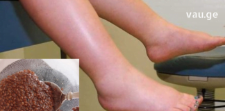 სასწრაფოდ!! ვისაც ფეხების შეშუპება აწუხებს ვურჩევთ გაეცნონ ამ ფასდაუდებელ რეცეპტებს, რომელთა დახმარებითაც პრობლემა ერთხელ და სამუდამოდ მოგვარდება..