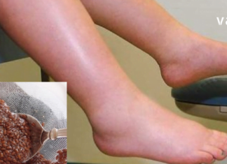 სასწრაფოდ!! ვისაც ფეხების შეშუპება აწუხებს ვურჩევთ გაეცნონ ამ ფასდაუდებელ რეცეპტებს, რომელთა დახმარებითაც პრობლემა ერთხელ და სამუდამოდ მოგვარდება..