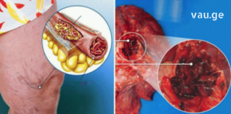 გაგიზიარებთ იმ პროდუქტთა ჩამონათვალს, რომლებიც სრაფად ათხელებს სისხლს და გამორიცხავს თრომბის რისკს!