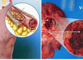 გაგიზიარებთ იმ პროდუქტთა ჩამონათვალს, რომლებიც სრაფად ათხელებს სისხლს და გამორიცხავს თრომბის რისკს!