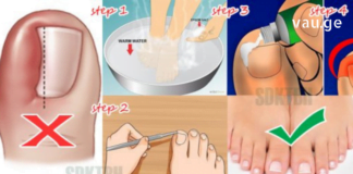 ნახეთ რა მარტივია ჩაზრდილი ფრჩხილის მკურნალობა ქირურგიული ჩარევების გარეშე