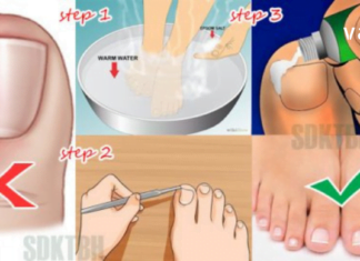 ნახეთ რა მარტივია ჩაზრდილი ფრჩხილის მკურნალობა ქირურგიული ჩარევების გარეშე