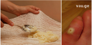 ვეღარ უმკლავდებით კოჟრებთან დაკავშირებულ სირთულეებს? მაშინ ეს სტატია თქვენთვისაა !