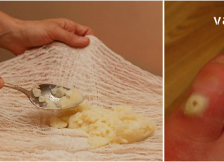 ვეღარ უმკლავდებით კოჟრებთან დაკავშირებულ სირთულეებს? მაშინ ეს სტატია თქვენთვისაა !