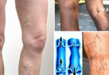 სისხლის ცუდი მიმოქცევის 4 მნიშვნელოვანი ნიშანი, რომელიც არ უნდა გამოტოვოთ! ეს არის თქვენი ჯანმრთელობისთვის ძალიან მნიშვნელოვანი