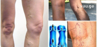 სისხლის ცუდი მიმოქცევის 4 მნიშვნელოვანი ნიშანი, რომელიც არ უნდა გამოტოვოთ! ეს არის თქვენი ჯანმრთელობისთვის ძალიან მნიშვნელოვანი