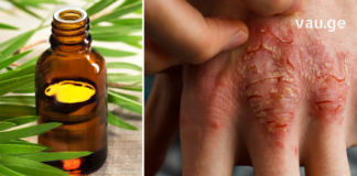 ეს უნივერსალური ზეთი ნამდვილი დამხმარეა – ფსორიაზი ამის წყალობით დავამარცხე!