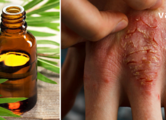 ეს უნივერსალური ზეთი ნამდვილი დამხმარეა – ფსორიაზი ამის წყალობით დავამარცხე!