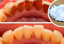 Მოიცილეთ კბილებზე ნადები, ქვები და ბაქტერიები, რომლებიც იწვევს პირის ღრუს არასასურველ სუნს, სულ რაღაც ერთი ინგრედიენტის დახმარებით!