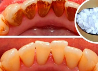 Მოიცილეთ კბილებზე ნადები, ქვები და ბაქტერიები, რომლებიც იწვევს პირის ღრუს არასასურველ სუნს, სულ რაღაც ერთი ინგრედიენტის დახმარებით!