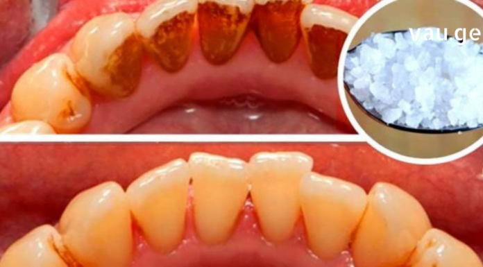 Მოიცილეთ კბილებზე ნადები, ქვები და ბაქტერიები, რომლებიც იწვევს პირის ღრუს არასასურველ სუნს, სულ რაღაც ერთი ინგრედიენტის დახმარებით!