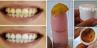 საოცარი მეთოდები, რომელთაც ცნობილი სტომატოლოგი გვირჩევს თეთრი და ჯანსაღი კბილებისთვის !