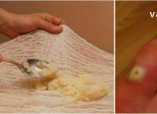 აქამდე უცნობი ყველაზე ეფექტური და უმტკივნეულო მეთოდები მაზოლების მოსაცილებლად!