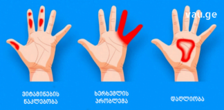 ხელების დაბუჟების 4 მიზეზი – ამის ცოდნა აუცილებელია
