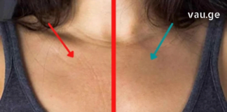 თქვენს წინაშეა გამოცდილი რეცეპტები ყელისა და დეკოლტეს მიდამოში ნაოჭების მოსაშორებლად!