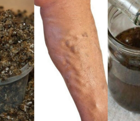 ნაყენი ბებიას სამზარეულოდან ჯანსაღი ვენებისთვის და სისხლის უკეთესი მიმოქცევისთვის!