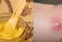 ამის შემდეგ სამუდამოდ განიკურნებით ძირმაგარასგან – დროში გამოცდილი რეცეპტები !