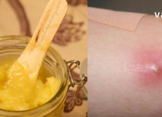 ამის შემდეგ სამუდამოდ განიკურნებით ძირმაგარასგან – დროში გამოცდილი რეცეპტები !