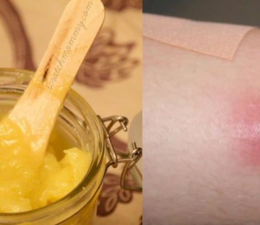 ამის შემდეგ სამუდამოდ განიკურნებით ძირმაგარასგან – დროში გამოცდილი რეცეპტები !