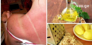 მზეზე დამწვრობის თავიდან ასაცილებლად საკმარისია ამ რამდენიმე მარტივი წესის დაცვა!