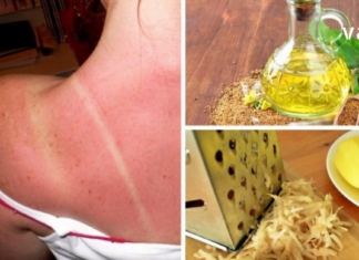 მზეზე დამწვრობის თავიდან ასაცილებლად საკმარისია ამ რამდენიმე მარტივი წესის დაცვა!