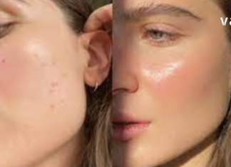 მე ვზრუნავ სახის კანზე: მარტივად ვასუფთავებ კანს აკნესგან და ვავიწროვებ ფორებს !