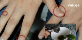 ეს არის საკმაოდ ეფექტური ხალხური მეთოდი, რომლის დახმარებითაც მეჭეჭების მოშორება სახლიდან გაუსვლელადაა შესაძლებელი.