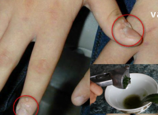 ეს არის საკმაოდ ეფექტური ხალხური მეთოდი, რომლის დახმარებითაც მეჭეჭების მოშორება სახლიდან გაუსვლელადაა შესაძლებელი.