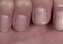 დროულად მიაქციეთ ყურადღება თქვენი ფრჩხილების მდგომარეობას. მატი მტვრევა განგაშის სიგნალია !