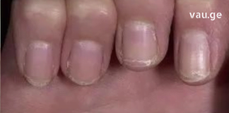 დროულად მიაქციეთ ყურადღება თქვენი ფრჩხილების მდგომარეობას. მატი მტვრევა განგაშის სიგნალია !