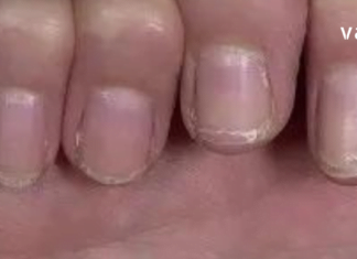 დროულად მიაქციეთ ყურადღება თქვენი ფრჩხილების მდგომარეობას. მატი მტვრევა განგაშის სიგნალია !