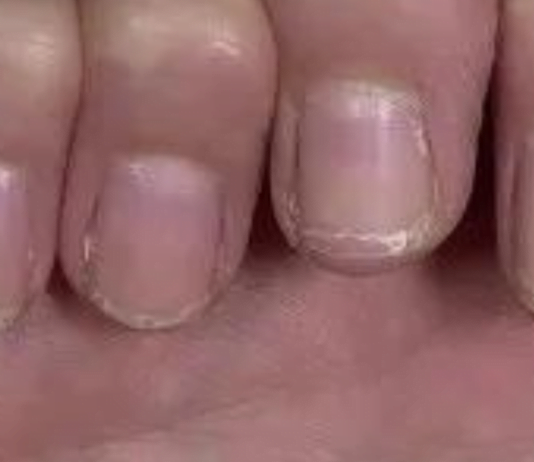 დროულად მიაქციეთ ყურადღება თქვენი ფრჩხილების მდგომარეობას. მატი მტვრევა განგაშის სიგნალია !