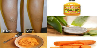 ამ რეცეპტმა გადაარჩინა ჩემი დედამთილი – ძლიერი სამკურნალო ნაყენი ვარიკოზული ვენების წინააღმდეგ!