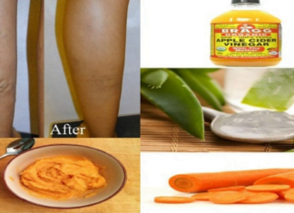 ამ რეცეპტმა გადაარჩინა ჩემი დედამთილი – ძლიერი სამკურნალო ნაყენი ვარიკოზული ვენების წინააღმდეგ!